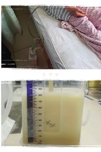 术前:每日乳糜胸引流量1200毫升左右.