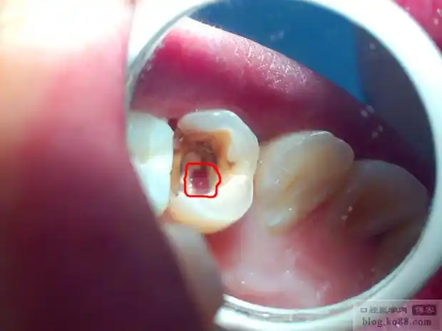 一例前磨牙根管侧穿再治疗!