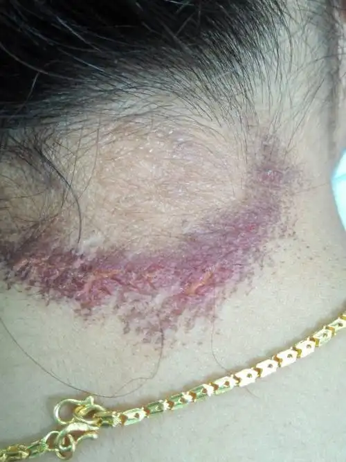 以前脖子上只是指甲盖大小的癣,经医生开药用氟轻松酊2天,严重过敏,现