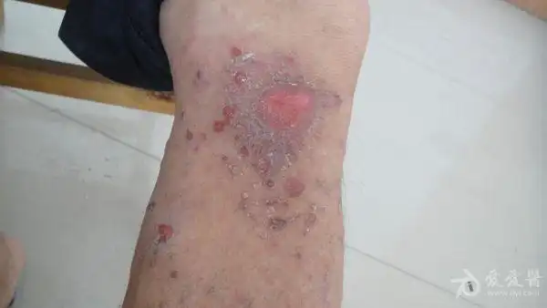 传染性湿疹样皮炎 - 皮肤及性传播疾病讨论版 - 爱爱医医学论坛