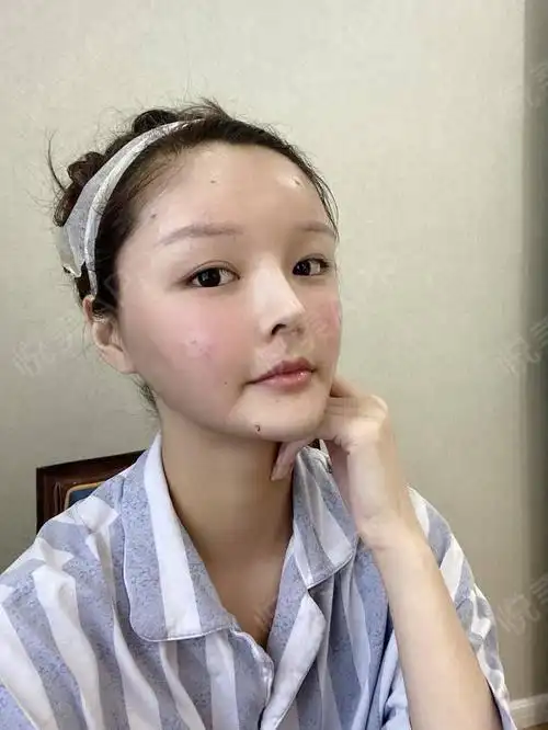 自体脂肪面部填充术后51天_面部填充术后51天_自体脂肪术后51天_雪