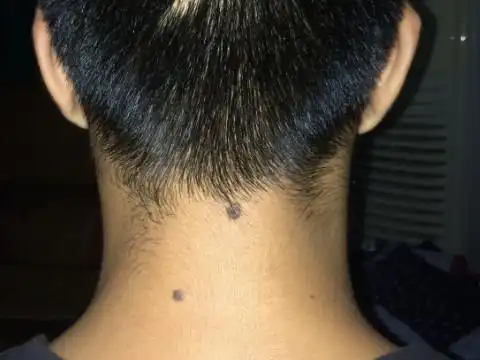 苦情痣分析长有苦情痣的人婚姻不顺吗