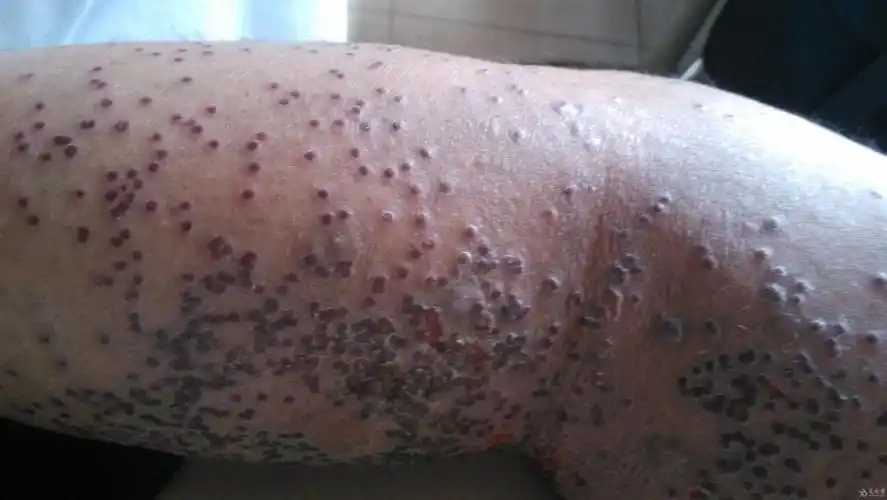 一老外 腿上严重的皮肤病 请教大家 - 皮肤及性传播疾病讨论版 - 爱爱