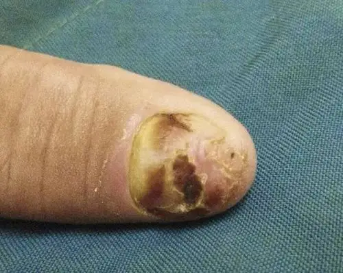 患者女,61 岁,3 年指甲畸形伴有左手拇指的无痛性溃疡史,病变部位