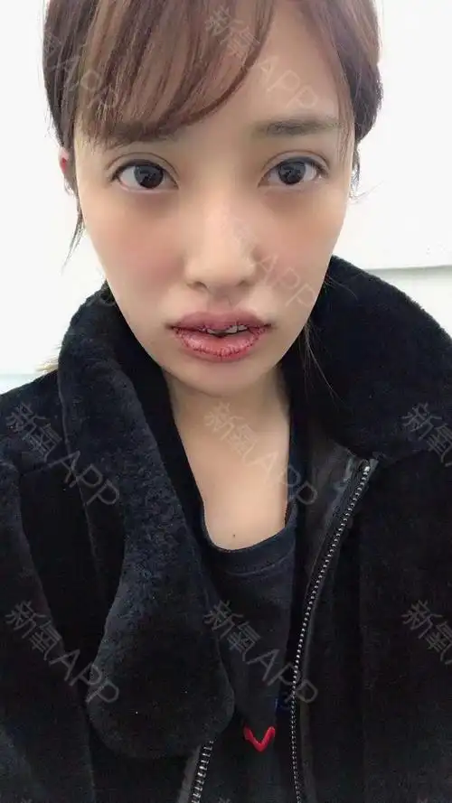 上下唇改薄 上唇m术后当天的效果,本来只做上下唇改_圈子-新氧美容