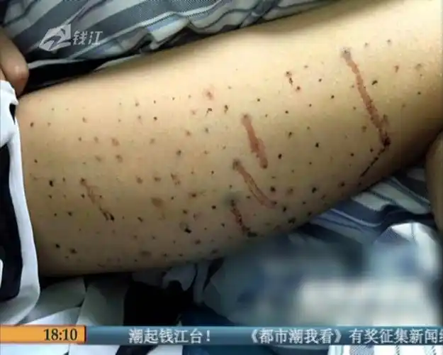 女孩为减肥腿上扎100个窟窿眼险丧命 为变美也是蛮拼的