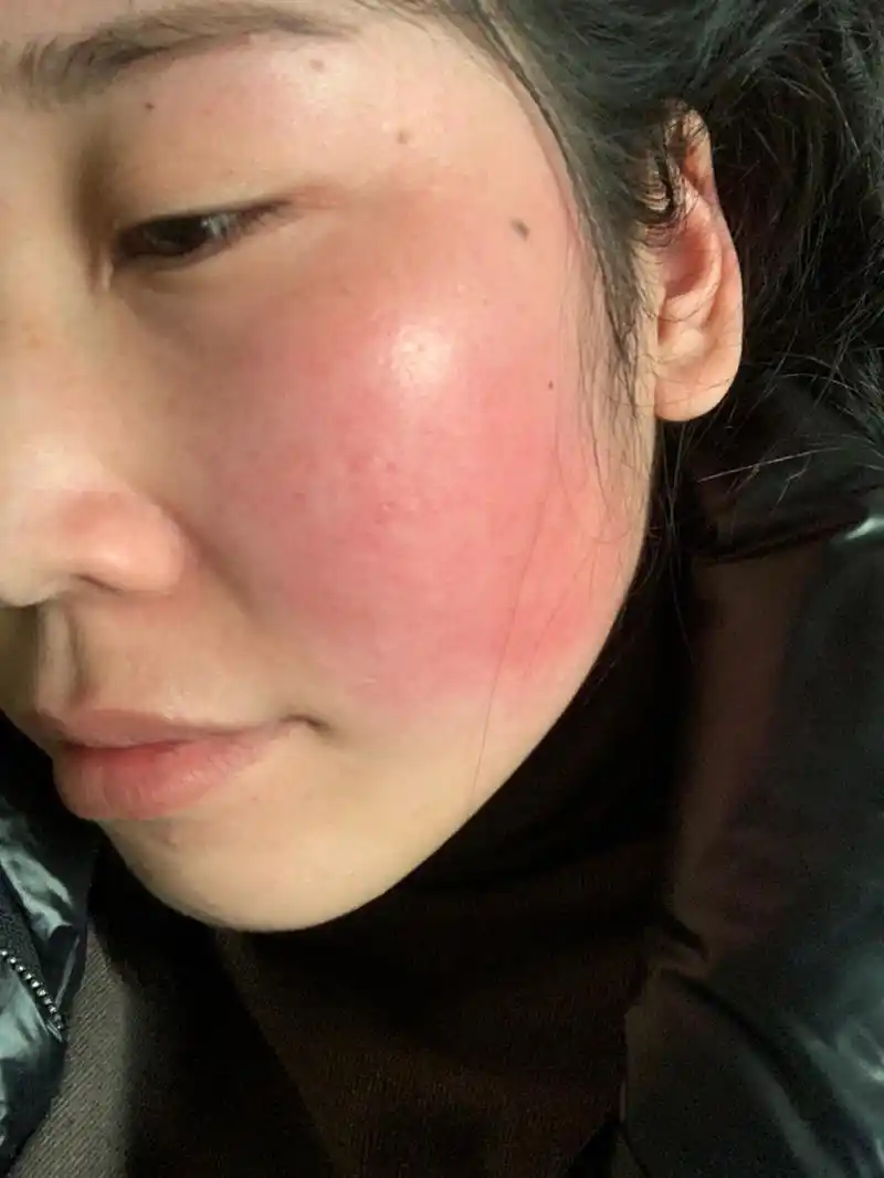 脸每天都是红的,平时红但没什么感觉,预热冷空调房间待一会就会又红又
