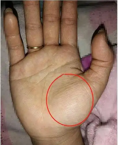 你手上的金星丘如果出现了横纹,一定要引起重视,特别是女性!
