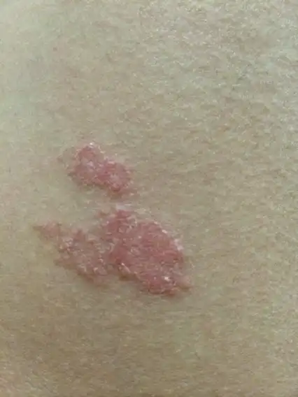 本人男,大腿上长了一块癣,请问怎么办