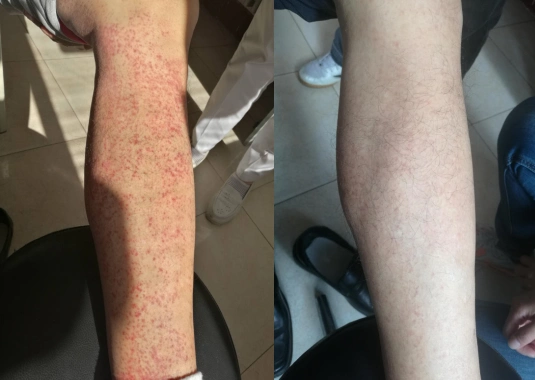 健康疗法治疗单纯性过敏性紫癜,带状疱疹,湿疹,银屑病,荨麻疹等皮肤病