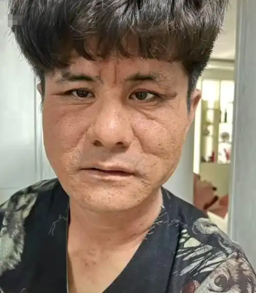 星光大道草根冠军晒近况面部湿疹皮肤剥落自爆欠下千万债务