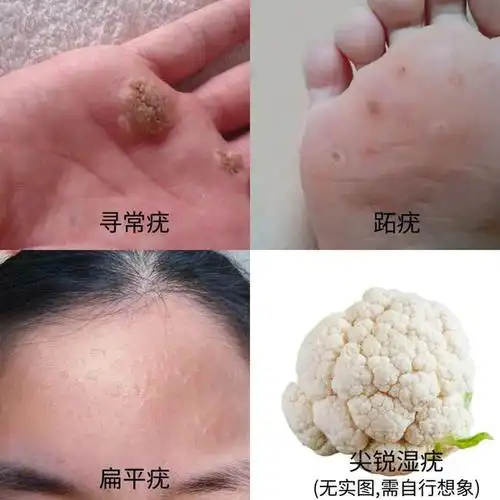 超80女性一生至少有过一次hpv感染出现这几个症状要小心了