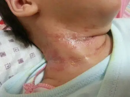 问:宝宝脖子出现溃烂现象,不能涂抹爽身粉,该用什么