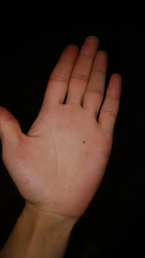 我男生 21岁 左手上面有这样的一颗痣 是啥子意思 谁能分析分析 谢谢