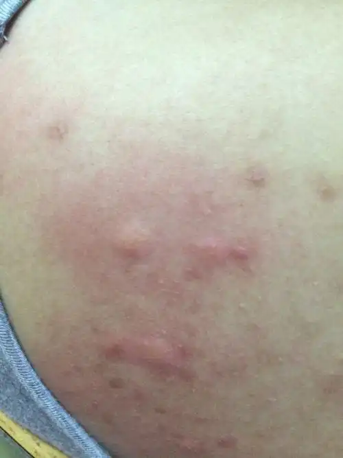 我要疯了啊,后背长很多这样的东西,昨天晚上痒得睡不着,这到底是什么