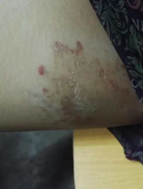 大腿根部两侧有红斑,有时会很痒,平时勤洗澡,夏天一天洗一次,冬天2 3