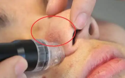 对不起!深圳潮生活推荐的9块9去黑头,闯大祸了