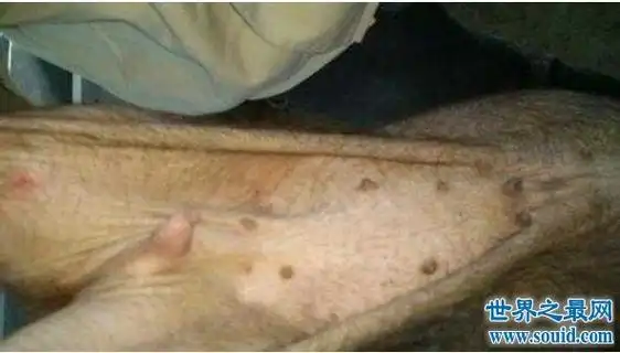 什么是阴阳人阴阳人有着男性睾丸和女性卵巢图片