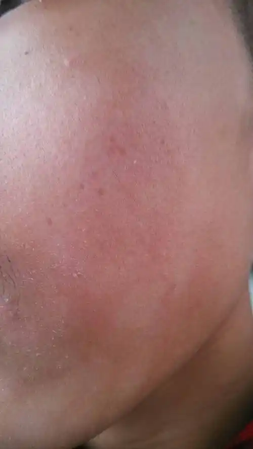 我脸上有白色癣,有的时候还有些痒,有的地方还有些轻微起皮,这是什么