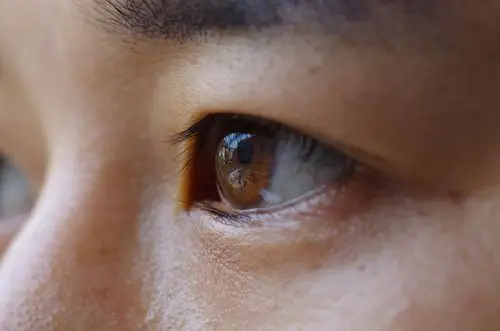 肝不好的人眼睛长这样看看你的眼睛是不是这样的