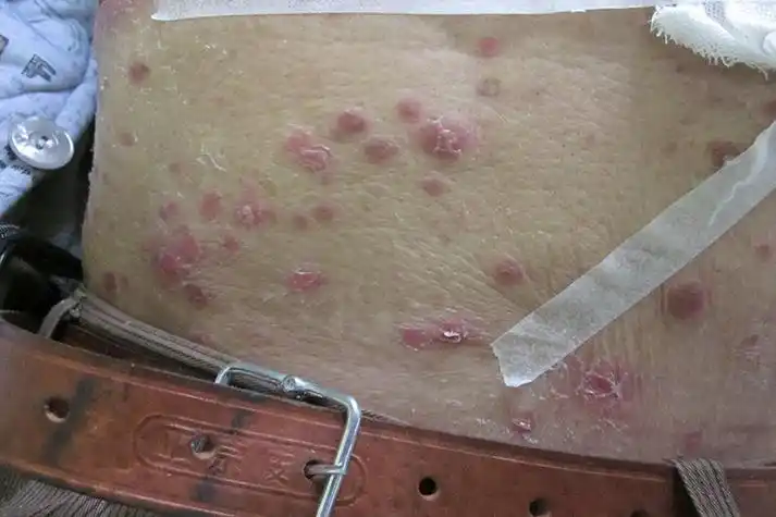 梅毒的症状是什么样_互联健康