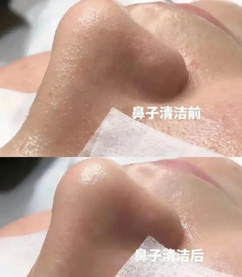 毛孔清洁带来的快乐