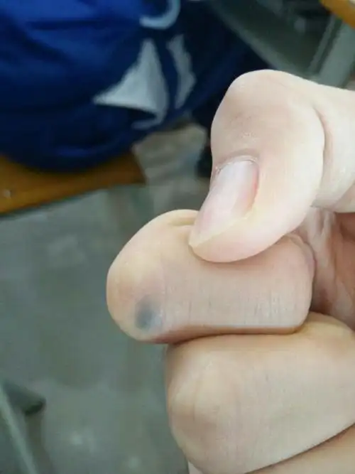 我的手指中间长了一个好奇怪的黑点, 有一点点凸,好几年了还是这样.