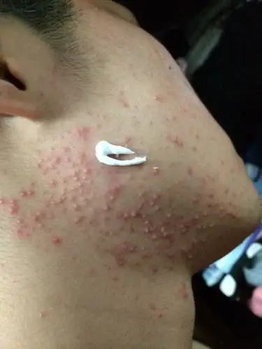 请问这是毛囊炎吗?我就这两天突然冒出来这么多,不懂怎么办!有点痒!