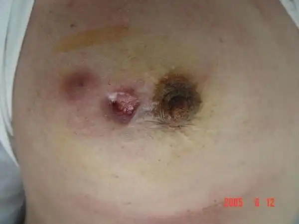 我们让浆细胞性乳腺炎一次治愈有图