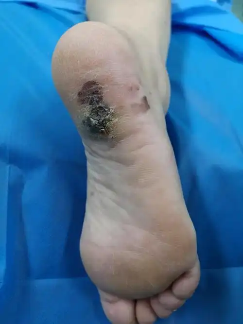 肢端皮肤恶黑表现 - 好大夫在线