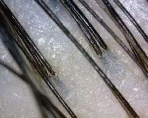 正常头皮毛囊图