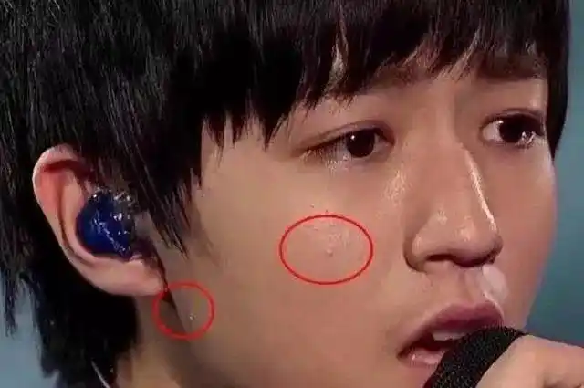 王俊凯长痘被吐槽,青春期长痘痘不很正常么?