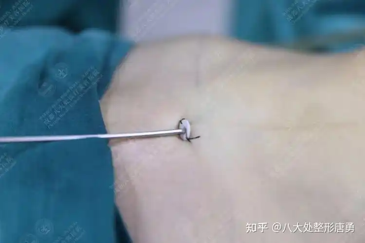 科普篇 | 腰腹吸脂手术全过程,手术前先知道!