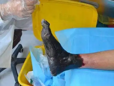 脚部组织坏死,触之粗糙,干燥,此时病变皮肤因水分散失较多,坏死区干燥