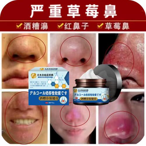 红鼻子草莓鼻专用毛孔粗大收缩清洁去螨虫粉刺药治祛修复酒糟鼻膏