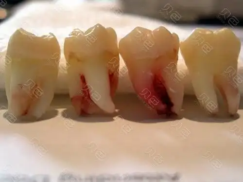 牙齿正在疼想直接去拔掉,牙医分析后再也不冲动了.