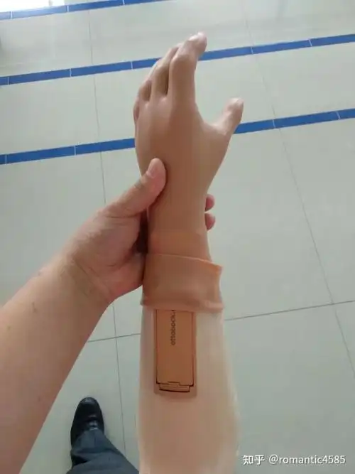 需要多锻炼,而且尽早装配假肢,肌电信号强烈.