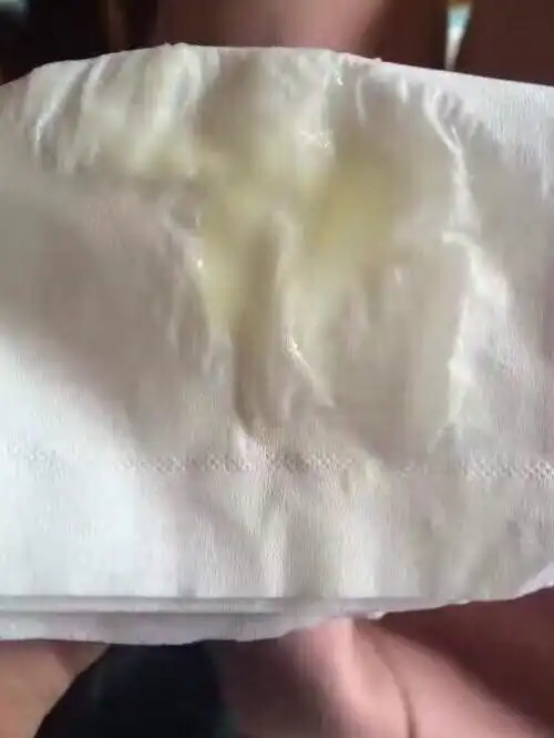 教你通过白带就可以分辨出来子宫卵巢的健康情况!