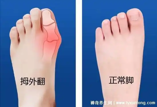 拇外翻图片与正常脚图片