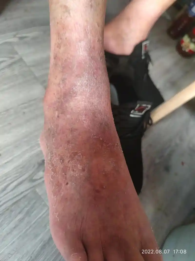 皮肤问题又一成功案例:86岁的老人,双脚小腿起皮骚痒一年多 - 抖音
