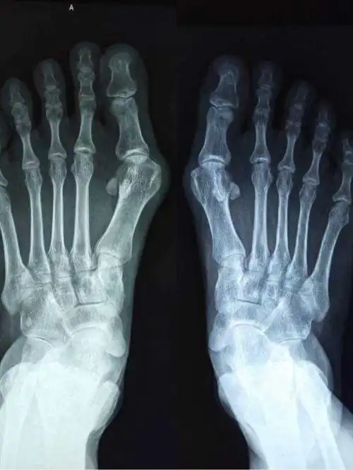 丰台广济医院带您看大脚骨的影像学特征