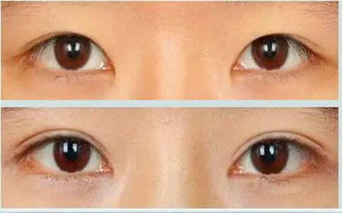 一只双眼皮另一只单眼皮怎么办?