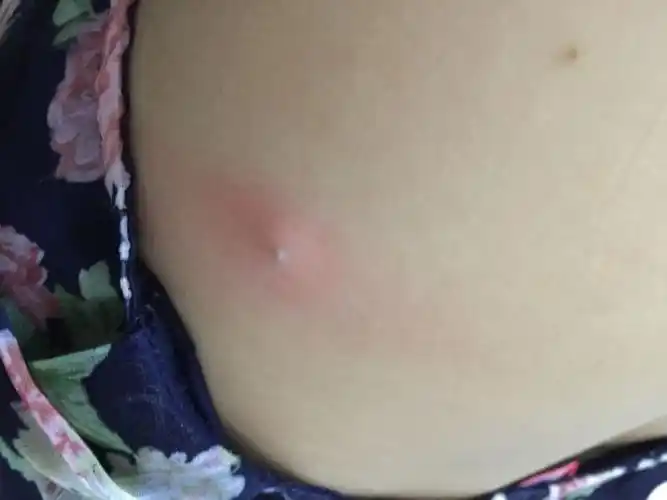 背上长了颗痘痘,正好是穿内衣带子包住的地方,摸着痛,怎么?