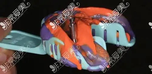 种植牙三期戴牙冠疼吗种牙三期取牙模及戴牙冠步骤详解