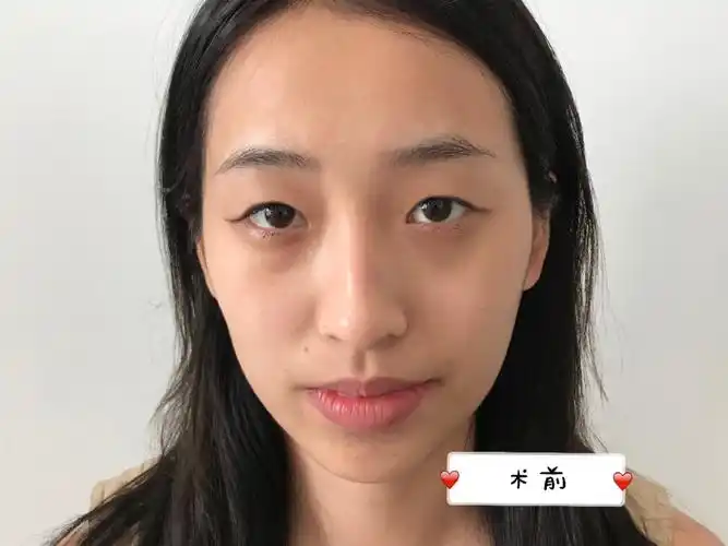 78天生单眼皮,双眼形态不佳,眼睛_圈子-新氧美容整形