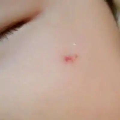 宝贝三个月了,脸上的红血丝块一个月钱长出来的.请问会自己吸收吗?