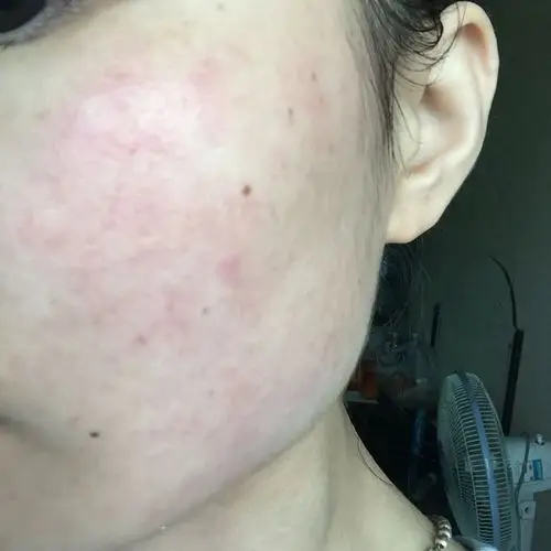 角质层受损红血丝