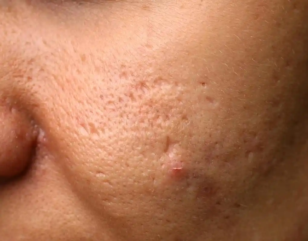 毛孔粗大怎么修复有效 毛孔粗大的修复方法包括:温和清洁,补水保湿