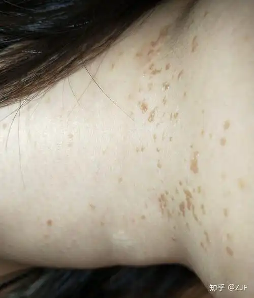 分享给大家十年扁平疣的治愈历程,花了几万块钱没治好,最后被十块钱的