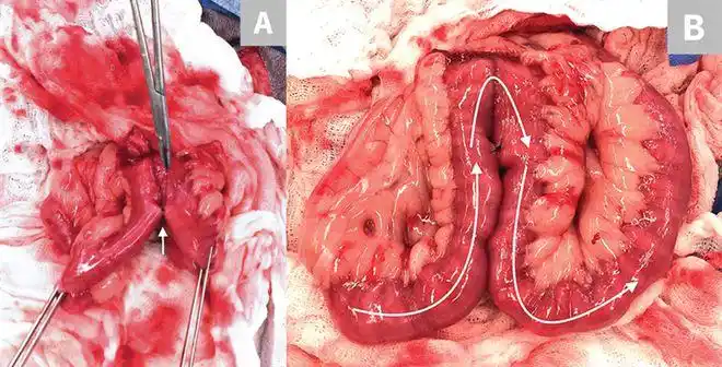 胃肠吻合术使用线型吻合器的六大步骤